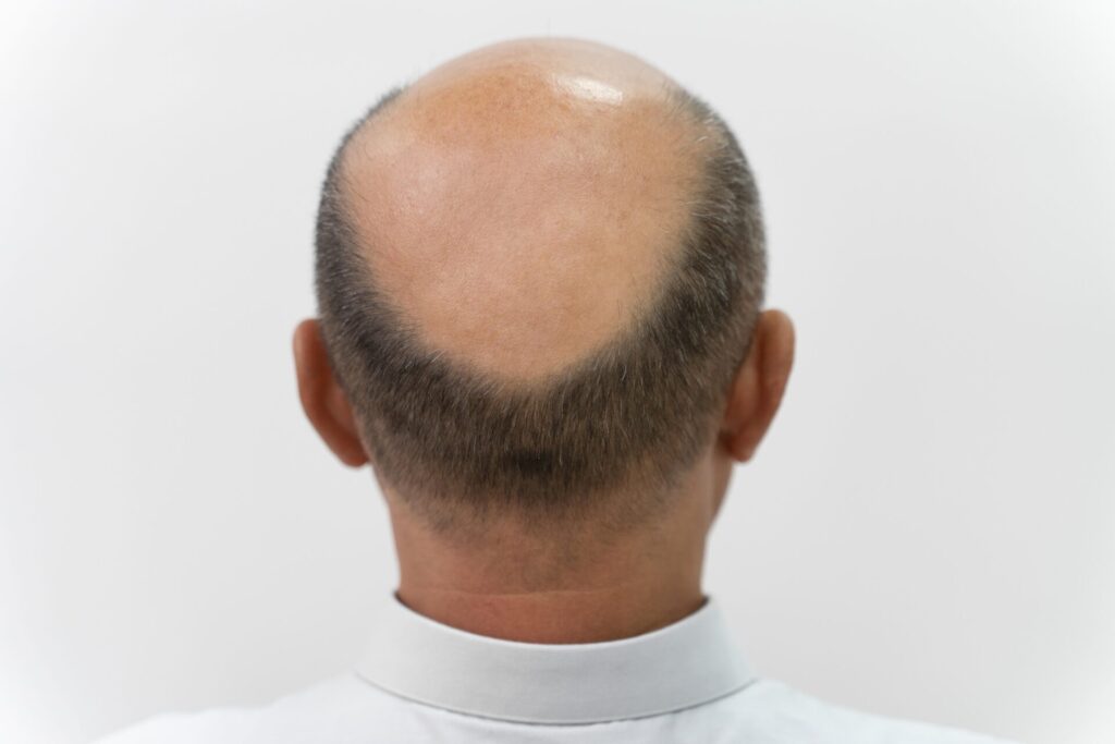 Uomo affetto dal alopecia androgenetica. 