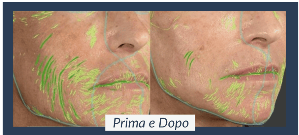 microneedling prima e dopo