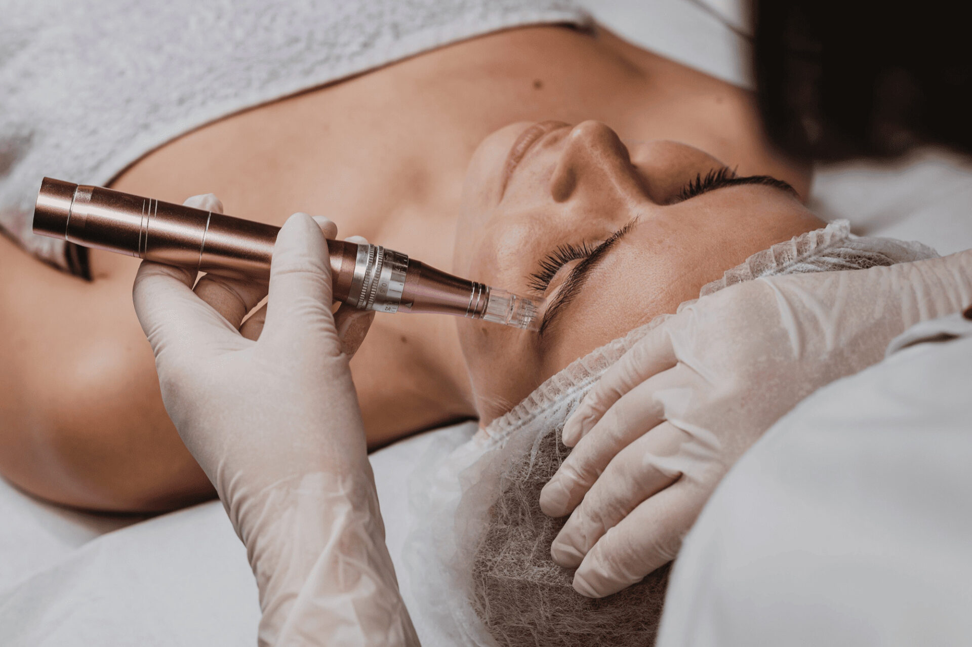 cos'è il microneedling